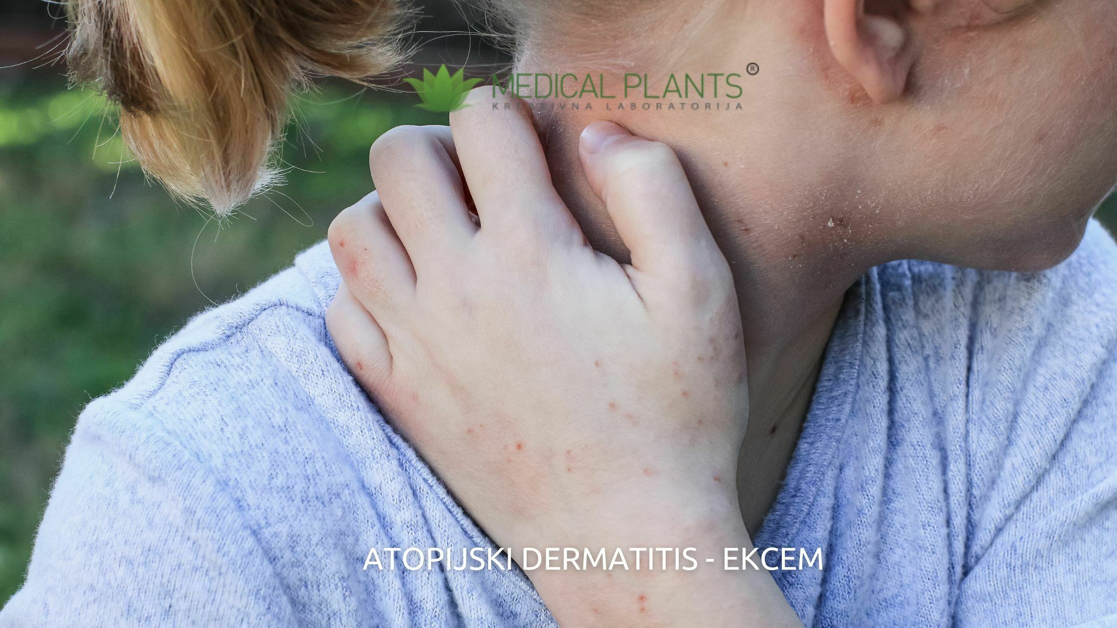 medic plants - atopijski dermatitis - ekcem